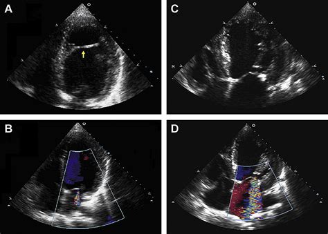 lv false tendon|false chord echo.